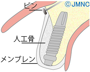 骨移植