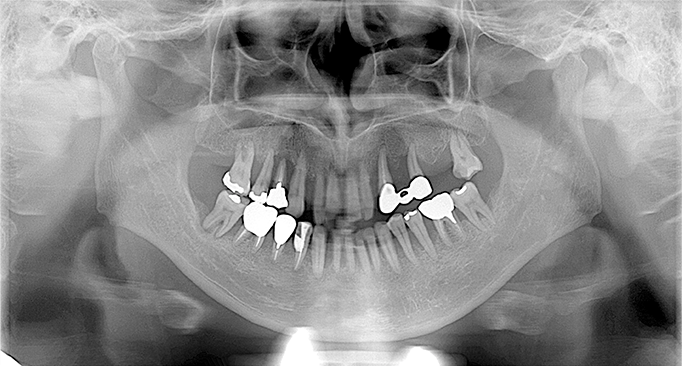 All-on-6による抜歯即時埋入・即時荷重　Before（レントゲン）