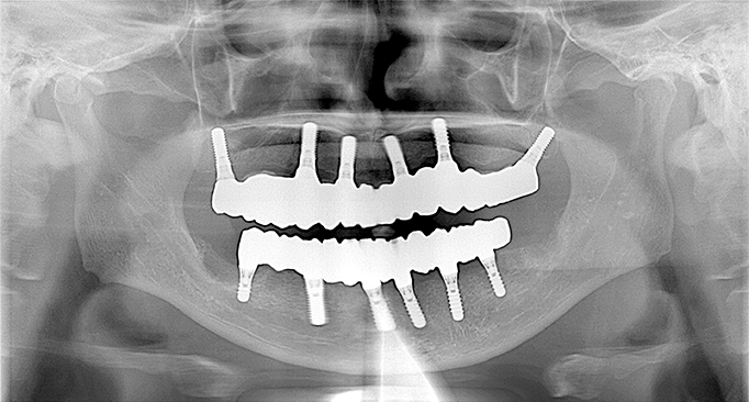 All-on-6による抜歯即時埋入・即時荷重　After（レントゲン）