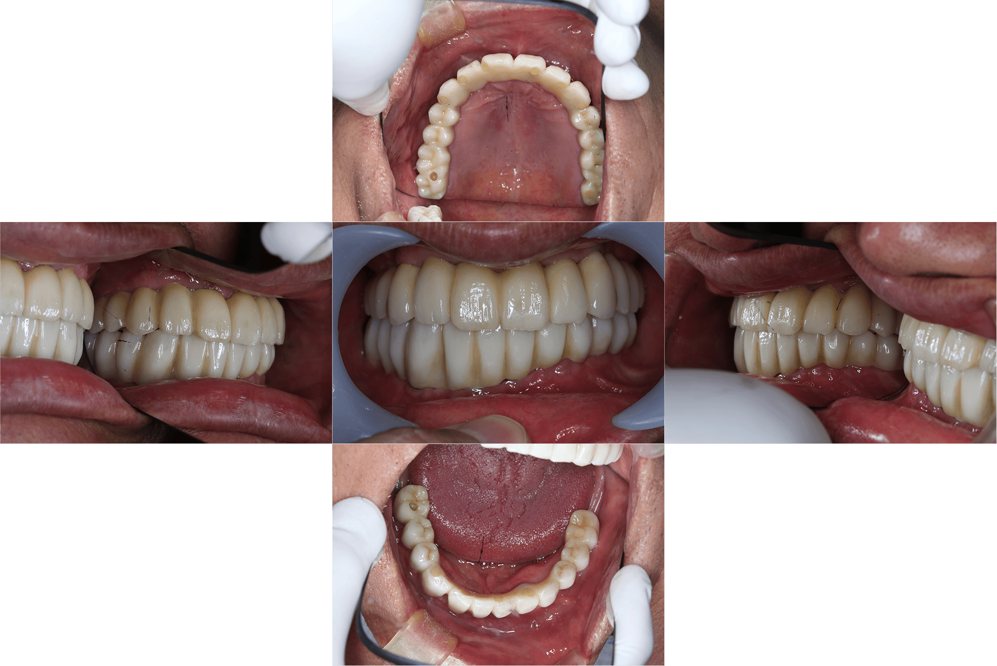 残存歯の抜歯、インプラントによる咬合回復 after