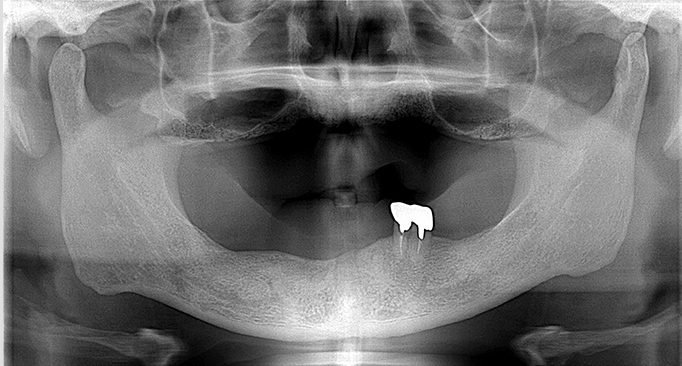残存歯の抜歯、インプラントによる咬合回復 Before（レントゲン）
