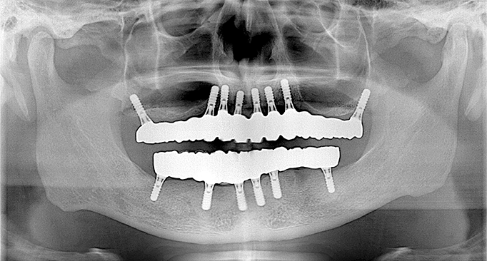 残存歯の抜歯、インプラントによる咬合回復 After（レントゲン）