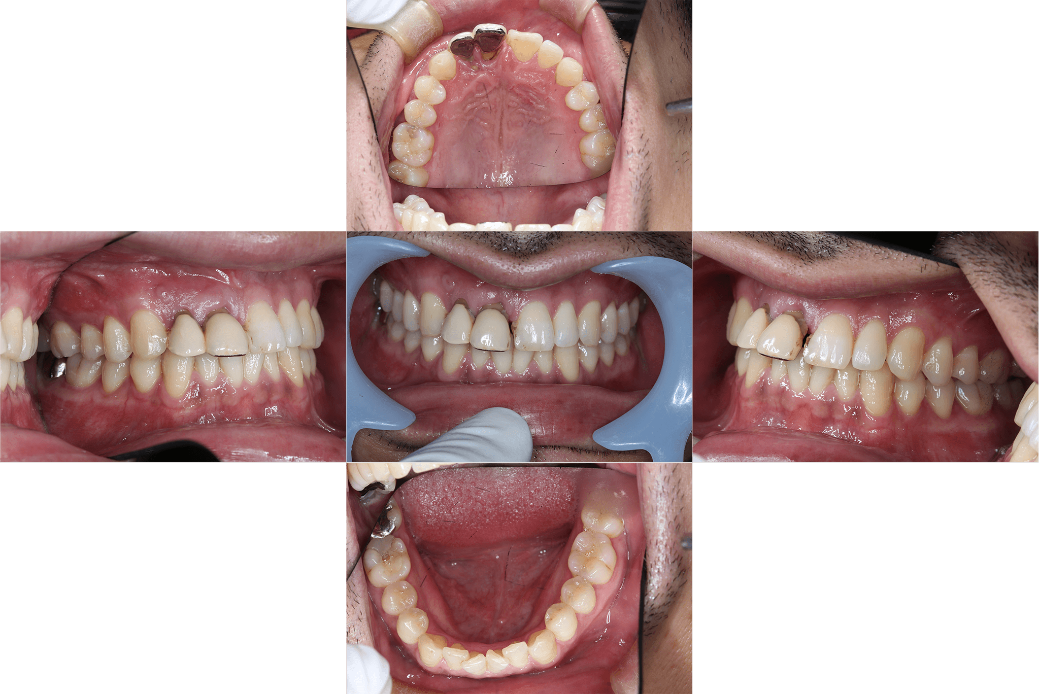 上顎前歯のインプラントによる治療抜歯後待機してから結合組織移植を併用して埋入 before