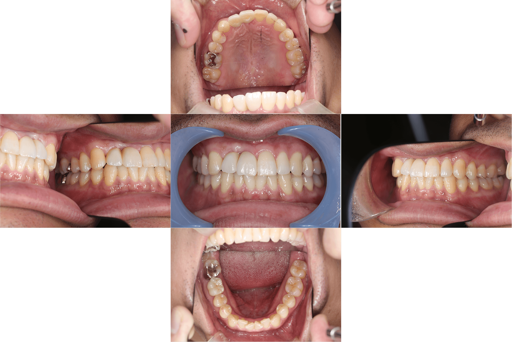 上顎前歯のインプラントによる治療抜歯後待機してから結合組織移植を併用して埋入 after