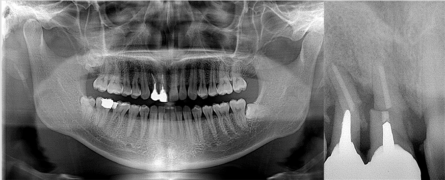 上顎前歯のインプラントによる治療抜歯後待機してから結合組織移植を併用して埋入 Before（レントゲン）