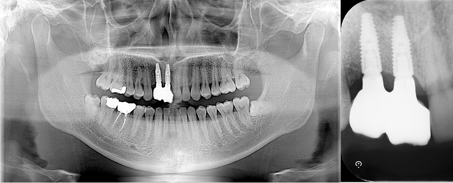 上顎前歯のインプラントによる治療抜歯後待機してから結合組織移植を併用して埋入 After（レントゲン）
