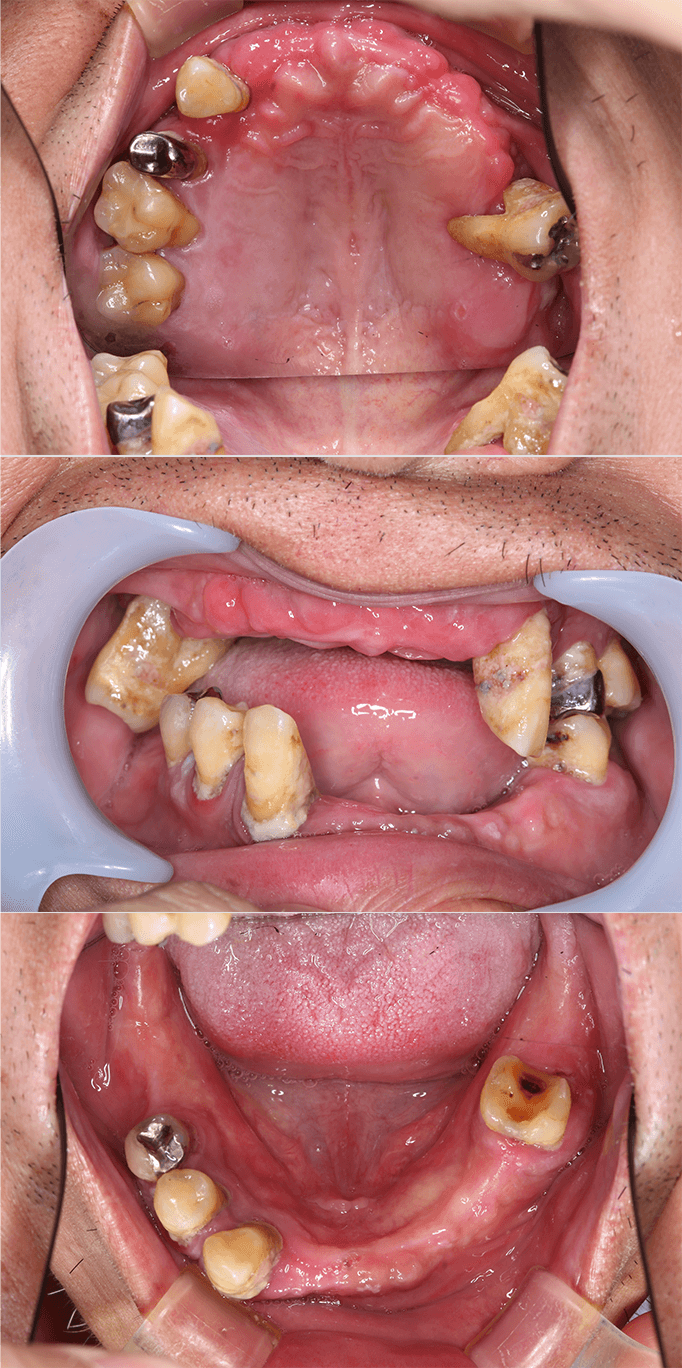 保存不可能な歯牙をすべて抜歯後上下を固定性インプラントブリッジで治療 before