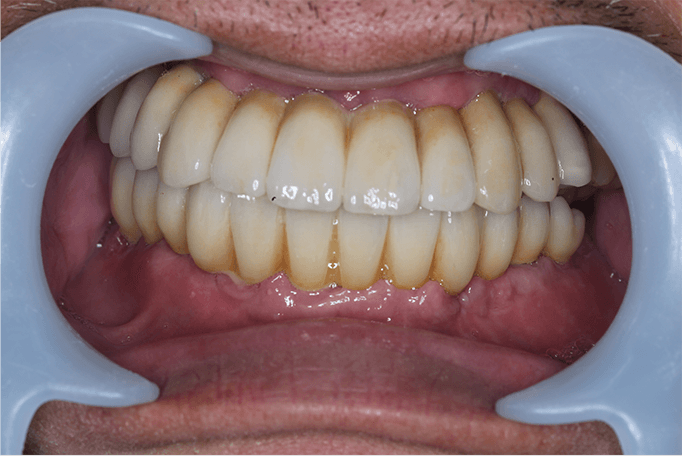 保存不可能な歯牙をすべて抜歯後上下を固定性インプラントブリッジで治療 after