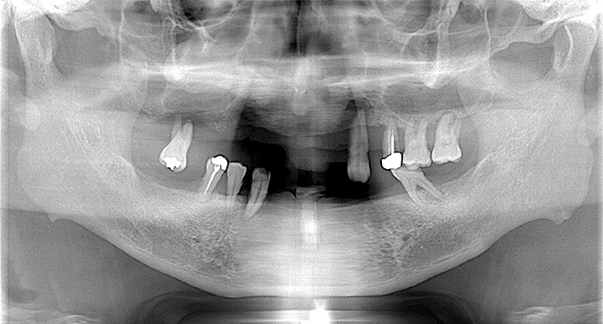 保存不可能な歯牙をすべて抜歯後上下を固定性インプラントブリッジで治療 Before（レントゲン）