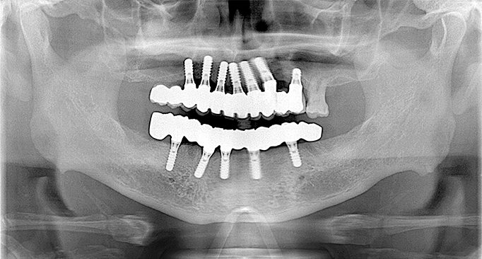 保存不可能な歯牙をすべて抜歯後上下を固定性インプラントブリッジで治療 After（レントゲン）