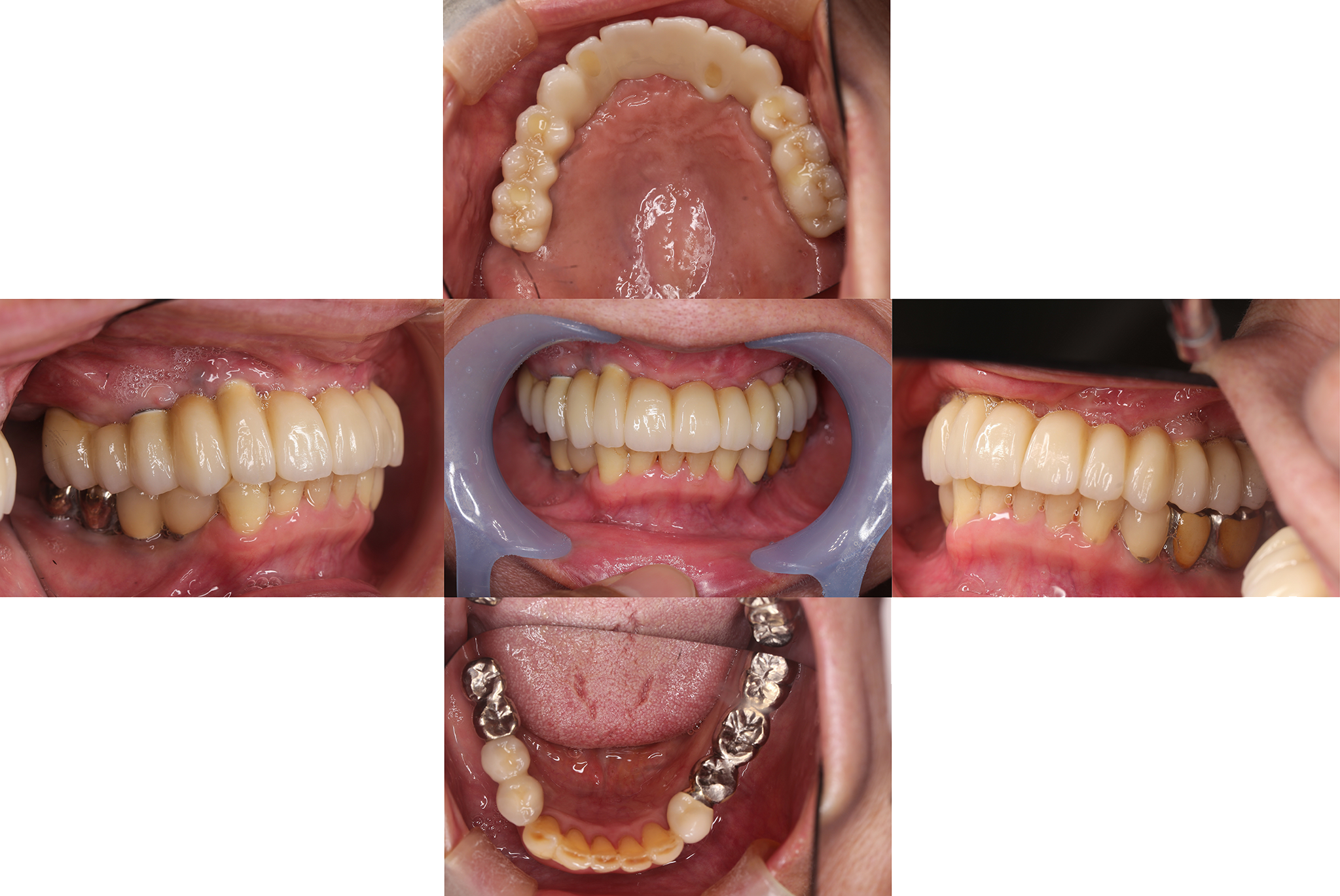 左右の骨が少なく両側のサイナスリフトを行いオールオン６にて固定性の治療。埋入と同時に即時荷重を行った。 after